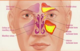 chronic sinusitis risk factors